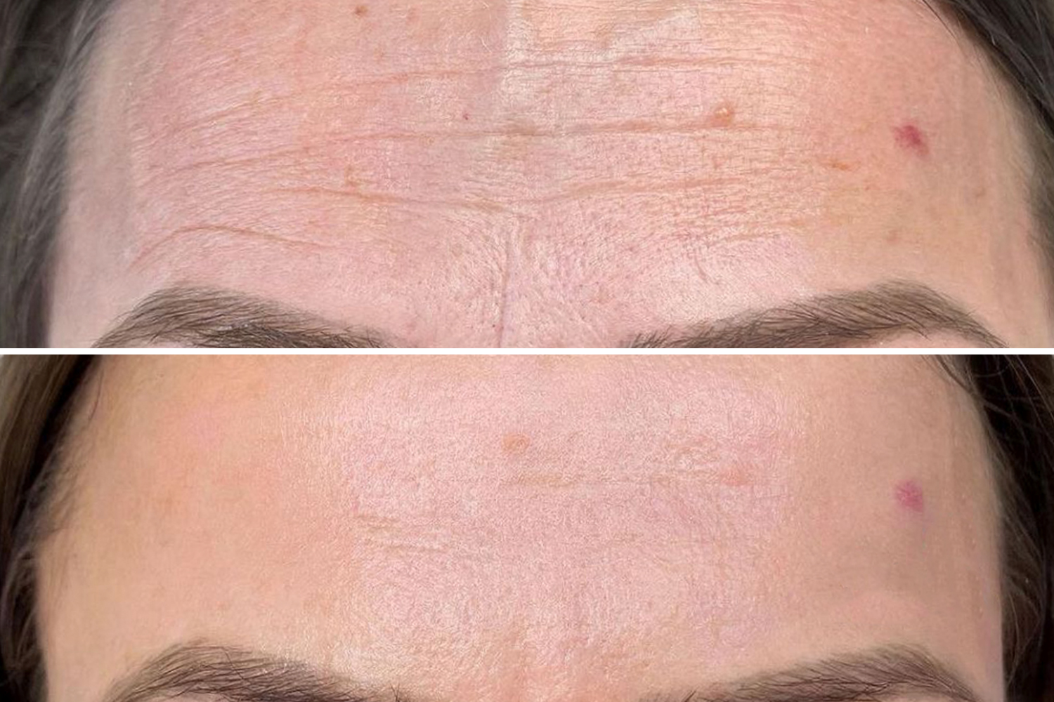 PhiIon Technician - Svitlana Bidzilia performing microneedling treatment. PhiIon Technician - Svitlana Bidzilia performing microneedling treatment.