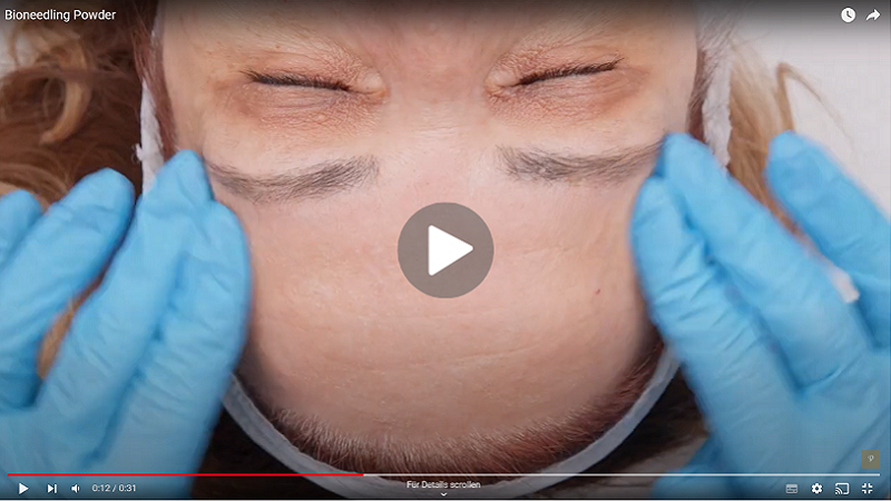 Step-by-Step Bioneedling Treatment Video Step-by-Step Bioneedling Treatment Video